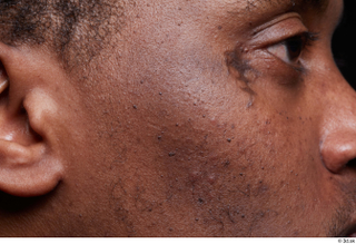 HD Face Skin Demarien Smith cheek ear face scar skin…
